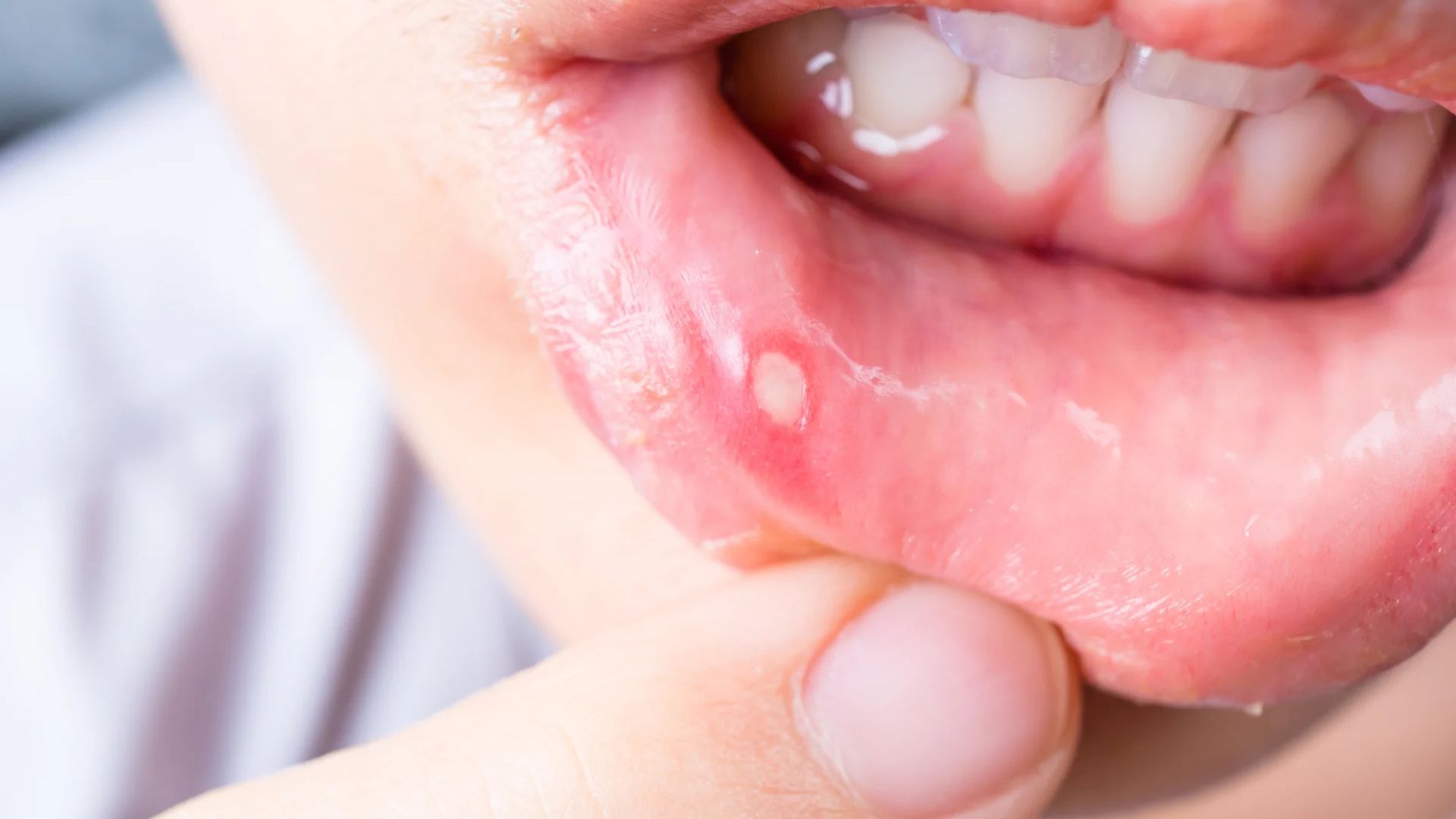 Canker Sores on the Tonsils: Boosting Immunity for Prevention